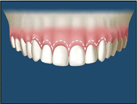 The outline of the new smile line is cut into the gum tissue.