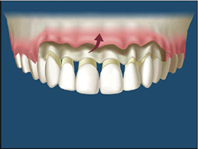 The excess bone is trimmed away, making room for the gum lift.