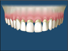 The gum is sewn up into the new position leaving the teeth looking too long.